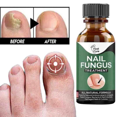 Nail Fungus Removal Gel (Imported)