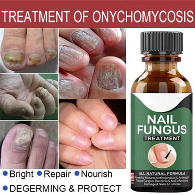 Nail Fungus Removal Gel (Imported)